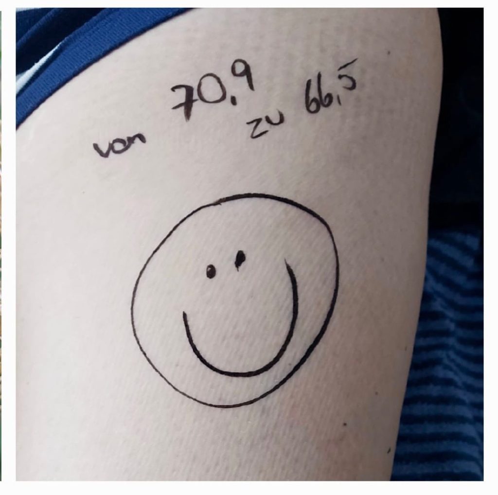 Lipödem mit Aurachirurgie ganz liebevoll verändern, Abnehmen